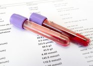Wybrane metody wykorzystywane do oceny funkcji płytek krwi
