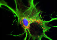 Płodowe komórki mózgu leczą chorobę Parkinsona